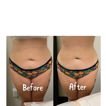 This client Cavitation, and the SNATCH ME UP-Laser Lipo and RF treatment done.