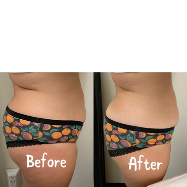 Body Sculpting, Laser lipo
