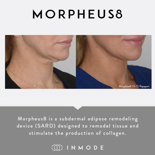Morpheus8 Before and After, Face