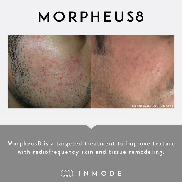 Morpheus8 Before and After, skin texture, tissue remodeling