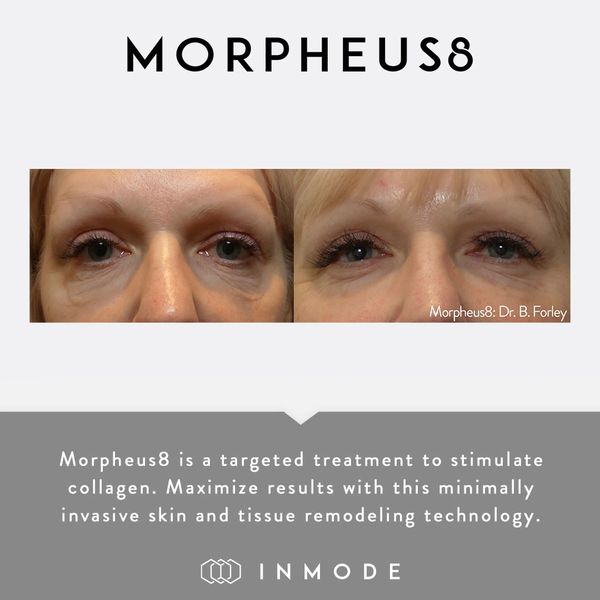 Morpheus8 Before and After, Eyes on face