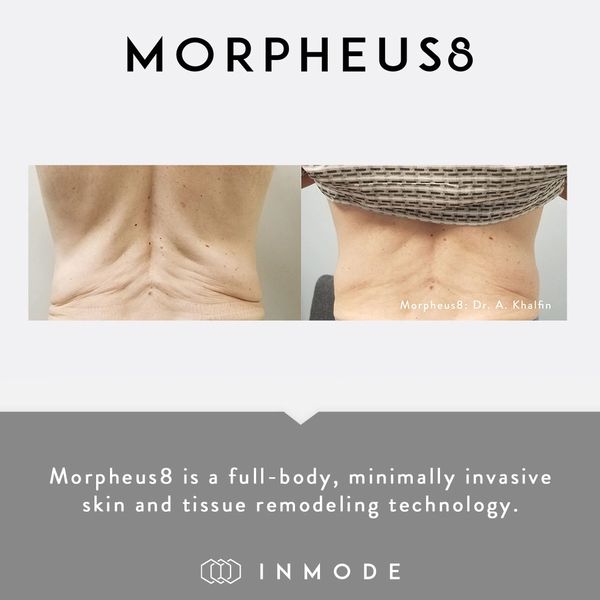 Morpheus8 Before and After, back