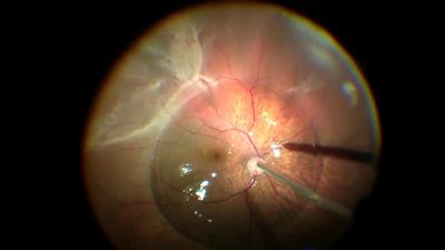 Vitrectomy surgery for complex retinal detachment