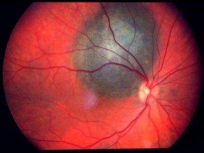 Choroidal melanoma