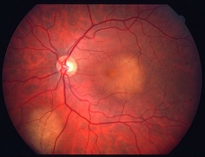 Choroidal metastases