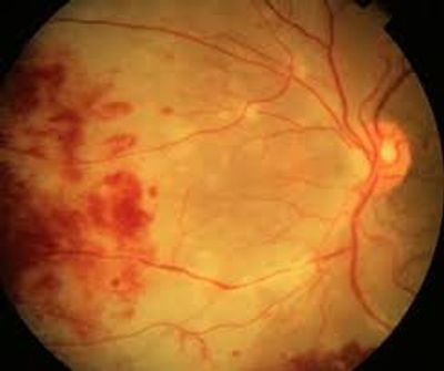 Cytomegalovirus (CMV) Retinitis