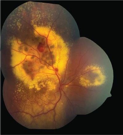 Coats' Disease of the retina.