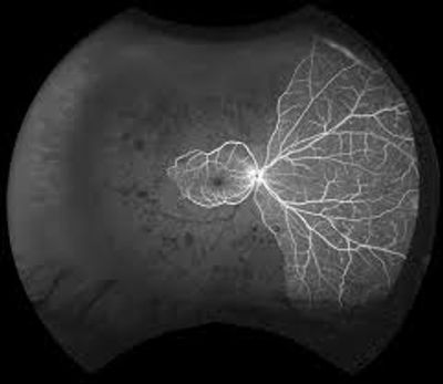 Ocular ischemic syndrome exhibiting retinal ischemia