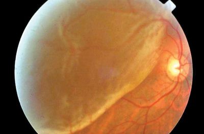 Retinal Detachment