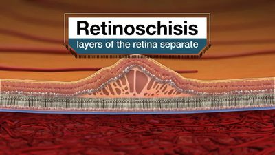 Retinoschisis