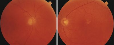 Cancer Associated Retinopathy