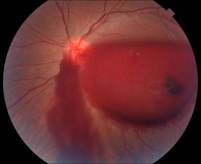 Vitreous Hemorrhage