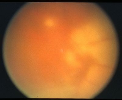 Toxoplasmic Chorio-Retinitis