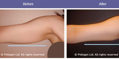 Elite Laser Center skin tightening before and after for arms