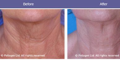 Elite Laser Center before and after pictures of skin tightening on neck