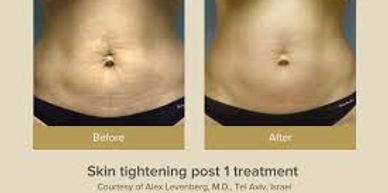 Elite Laser Center stomach skin tightening before and after