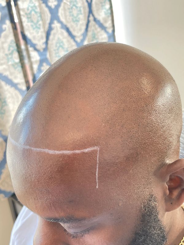 Scalp micro pigmentation before