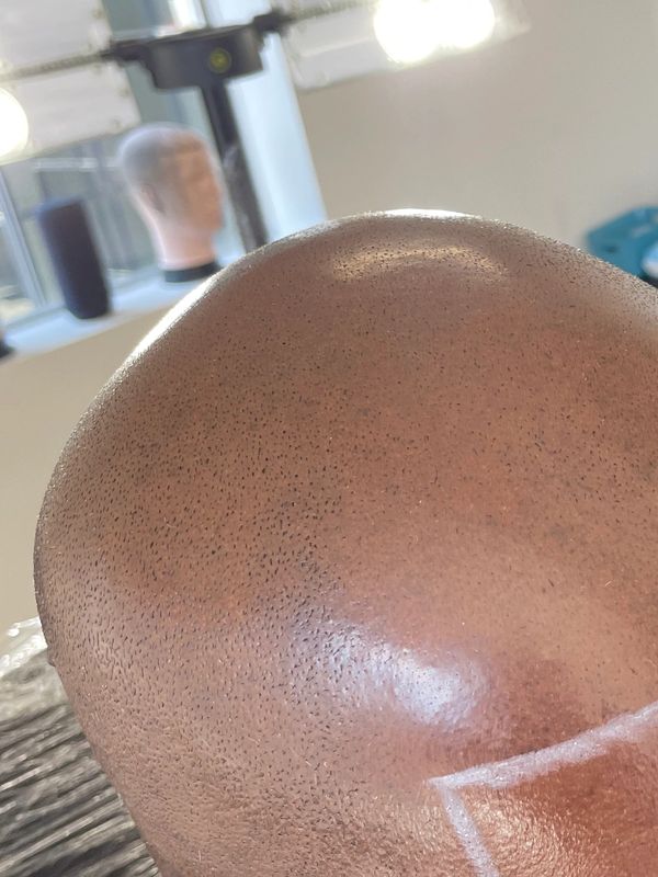 Scalp micro pigmentation before