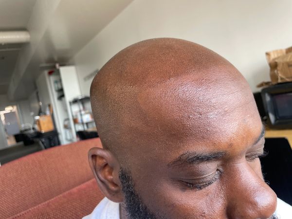Scalp micro pigmentation after