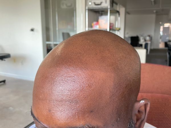 Scalp micro Pigmentation after