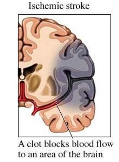 Brain Stroke