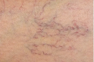 VARICOSE VEINS AND SPIDER VEINS - DR VIKASH JAIN - INTERVENTIONAL RADIOLOGIST, RAJKOT, INDIA