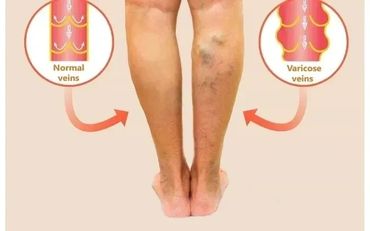 VARICOSE VEINS - SYMPTOMS AND CAUSES - DR VIKASH JAIN - INTERVENTIONAL RADIOLOGIST, RAJKOT, INDIA