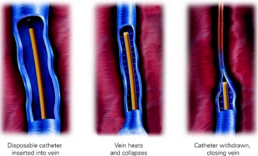 STATGES OF VARICOSE VEINS - DR VIKASH JAIN - INTERVENTIONAL RADIOLOGIST, RAJKOT, INDIA