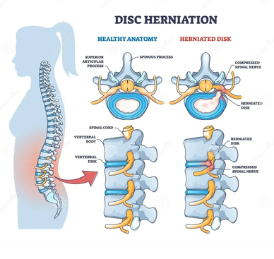 A stage of Spinal & Nerve Related