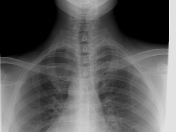 X-ray image showing the chest and neck area including the ribs and spine.