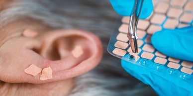 ear therapy acupuncture for ears ear seeds