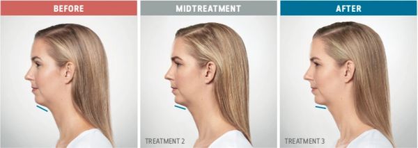 Alle Aesthetics Injectables Dermal Fillers botox juvederm volbella kybella latisse brilliant