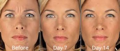 Alle Aesthetics Injectables Dermal Fillers botox juvederm volbella kybella latisse brilliant