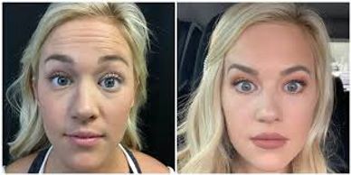 Botox, beauty, skincare, Galderma Aesthetics Injectables Dermal Fillers, juvederm,dysport, volbella,