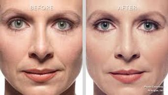 Botox, beauty, skincare, Galderma Aesthetics Injectables Dermal Fillers, juvederm,dysport, volbella,