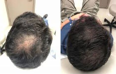 hair restoration, hair growth, prp, platelet rich plasma, beauty, ribestself, portsmouth ri