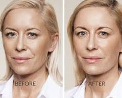 Botox, beauty, skincare, Galderma Aesthetics Injectables Dermal Fillers, juvederm,dysport, volbella,
