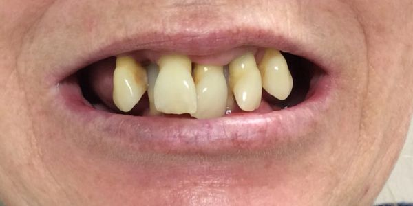 Before immediate denture at Dorset Park Denture Clinic