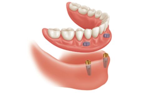 Lower implant denture at Dorset Park Denture Clinic