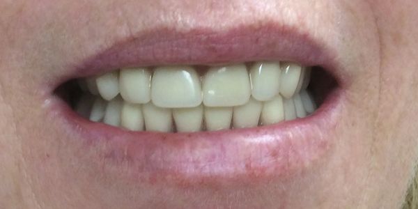 After Immediate denture at Dorset Park Denture Clinic