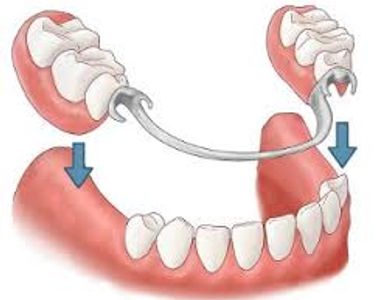 how to put in a partial denture, cast partial denture how it works