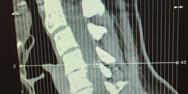 Meggen's neck xray showing damage