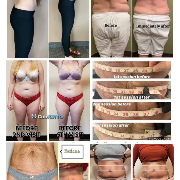 Cryo Body Sculpting / Body Contouring, Fat Freezing Before and After in Highland Village Salon. Argy