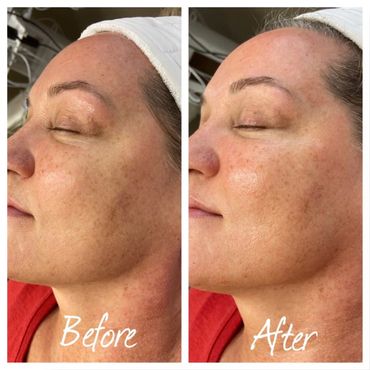 Before & After Dermaplaning