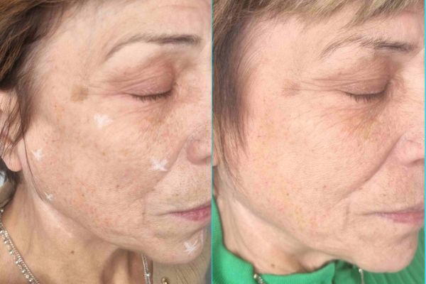 Skin Booster Before and After the Treatment