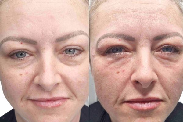 Skin Booster Before and After the Treatment