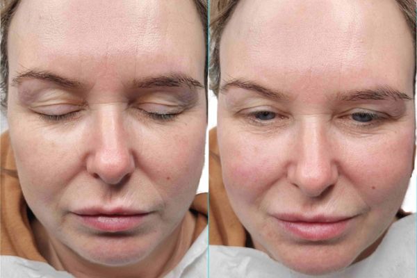 Skin Booster Treatment