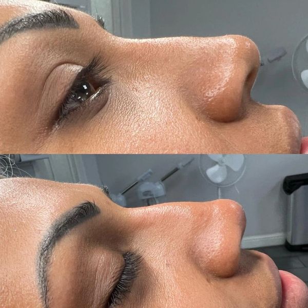 Non-surgical Rhinoplasty before and after