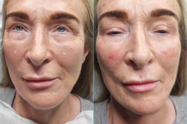 Skin Booster Before and After the Treatment