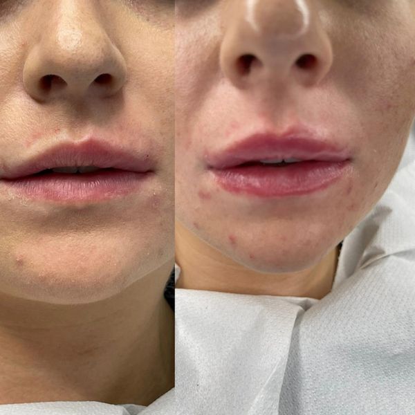Lip Filler Before and After